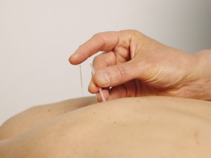 Acupuncture treatment being administered to a patient's back
