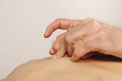 Acupuncture treatment being administered to a patient's back
