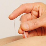 Acupuncture at The Physio Rooms