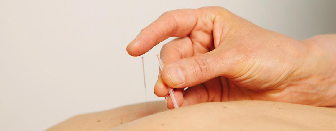 Acupuncture at The Physio Rooms